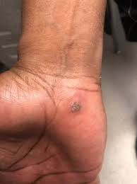 Image result for Papule