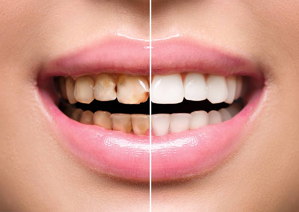 Scaling or Polishing product image