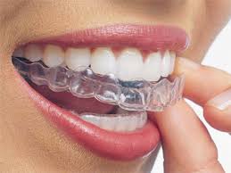 Clip on braces for teeth. Types Of Dental Braces In India The Dental Specialists