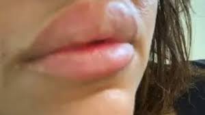 Le hyaluron pen est un nouveau venu dans l'industrie de la beauté. Ads For Dangerous Unregulated Lip Injections Flood Instagram And Snapchat