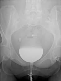 Image result for Voiding Cystourethrogram