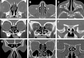 Normal Anatomy And Anatomic Variants Of The Paranasal Sinuses On Computed Tomography Neuroimaging Clinics