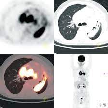 Pet Ct Principles And Applications In Lung Cancer Management Intechopen