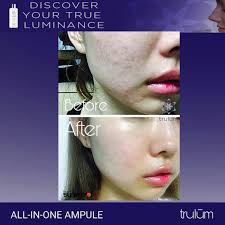 Read reviews and see what people are saying. Jual Trulum Plus Di Bluluk Lamongan Penghilang Flek Hitam Dan Jerawat Di Wajah