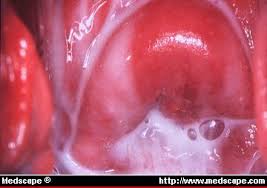 Is creamy white discharge 6 days after ovulation a sign of pregnancy? Watery White Discharge Types Causes And Treatments Conceive Success