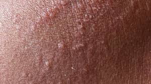 Image result for diaper dermatitis