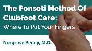 The ponseti method for clubfoot treatment the ponseti method has been practiced here at the university of iowa for 60 years since dr. The Ponseti Method Of Clubfoot Care Where To Put Your Fingers Youtube