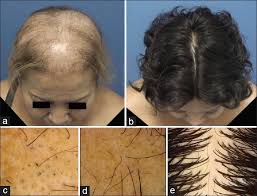 For the treatment of severe and intractable alopecia areata, such as alopecia universalis, totalis, diffusa etc., herb lotions are known to be effective in hair regrowth. Diffuse Alopecia Areata Associated With Weight Loss Pills Abstract Europe Pmc
