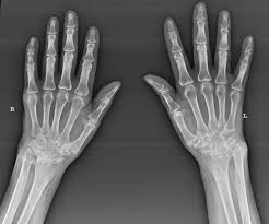 Image result for XRay Changes in Rheumatic Conditions