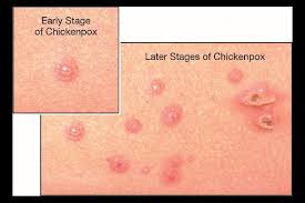 Membatasi aktivitas di luar rumah batasi aktivitas di luar rumah untuk membatasi penyebaran. Demam Campak Tanda Tanda Demam Campak Dan Tips Merawatnya Amynorami Com