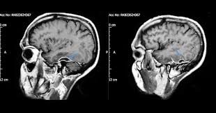 Le traitement a permis de réduire les abcès et l'homme a pu sortir de l'hôpital au bout d'une semaine. Cette Terrible Etude De Cas Montre Pourquoi Vous Devriez Arreter D Utiliser Des Cotons Tiges Pour Vous Nettoyer L Interieur Des Oreilles