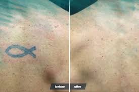 Tattoo removal creams are also cheaper than tattoo removal alternatives such as laser surgery, surgical excision, and real results and pain free! Tattoo Removal Ideas Tattoo Removal Before And After Body Tattoo Art