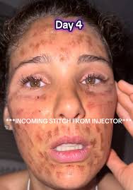 #stitch with @Kristina Santa AQUAPHOR + SUNSCREEN BABE YOU GOT THIS👏🏻  skin is resilient, I’m sorry this happened to you🥺 #rfmicroneedling  #microneedlingface #laserburn #microneedling #beautynurse ...