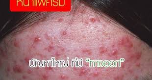 อาการหน าแพ คร ม เป นอาการท ม ส ทธ เก ดข นได ก บท กๆคน ตราบใดท เราย งต องทาคร มบำร งผ วมากมายหลายต วอย ท กๆเม อเช อว น โดยอากา