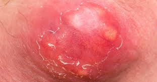 Bartholin's cysts manifest as firm, somewhat tender masses, and although they may occur at any age, they usually affect women in their reproductive years. Boils On The Buttocks Causes Treatment And Symptoms