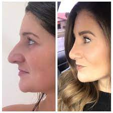 A nose job is usually done as an outpatient procedure, meaning there is no overnight stay. Rhinoplasty Lexington Ky