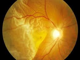 A torn retina usually has the same symptoms as a detached one. A Curtain Descends Litfl Ophthalmology Befuddler