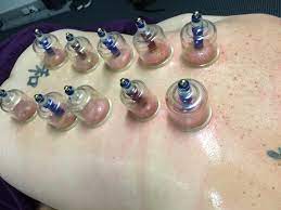 Aug 07, 2020 · now you know more about suction cups, why we are using them, and how they work. Cupping For Lower Back Pain Moveep