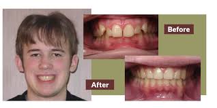 How to fix an overbite. Orthodontist In Andover Ma Invisalign Andover Orthodontics