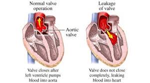Pin On Mitral Stenosis