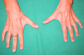 Ces motoneurones dégénèrent progressivement sans que l'on ne connaisse encore aujourd'hui l'origine. Correction D Une Amyotrophie De La Face Dorsale Des Mains D Origine Neurologique Par Autogreffe De Cellules Adipocytaires A Propos D Un Cas Original Sciencedirect