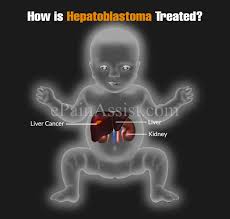 Infants and children (these are vaccinated as part of australia's national immunisation program). How Is Hepatoblastoma Treated Know The Survival Rate Stages Risk Factors Causes Symptoms Pathophysiology Of Hepatoblastoma
