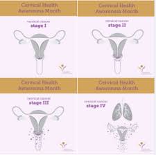 Some signs of cervical cancer are: January 2021 Saludable Latina