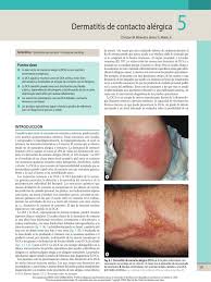 Image result for dermatitis contacta toxica