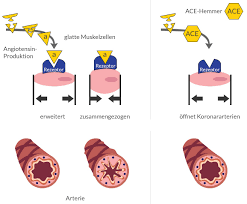 Die wirkstoffe ramipril, enalapril, benazepril, captopril und lisinopril (vesdil®, delix®, xanef®, cibacen®, lopirin®. Ace Hemmer Gegen Bluthochdruck Euroclinix Informiert