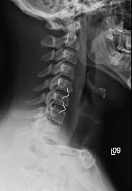 Maybe you would like to learn more about one of these? Cervical Spine Anatomy Diseases And Treatments