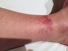 Commonly used as a natural cleaning agent, borax's reported number of successful treatments and health benefits are extensive. Are You At Risk For This Common Travel Malady