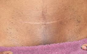 Welcome to laser hair removal fayetteville nc, where we offer elite electrolysis fayetteville nc and fayetteville nc laser hair removal services.if you are like the millions of men and women who are frustrated at the endless task of temporary grooming and the unpleasant irritations it can cause, then it is time you think about choosing laser hair removal as a permanent solution. Laser Hair Removal For Barrie Collingwood On Spa Lumina