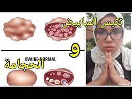 الحجامة تجربتي مع الحجامة تجربتي مع تكيس المباييض نصائح youtube