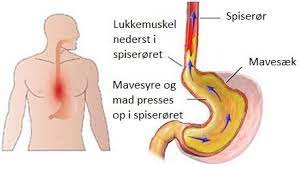 Heijeg er en kvinne på 39 år. Reflux Halsbrand Synkebesvaer Haeshed Sure Opstod Mavespecialisten