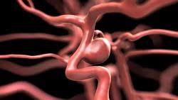 Un aneurisma cerebral es una protuberancia o dilatación en un vaso sanguíneo en el cerebro. Aneurisma Cerebrale Sintomi E Cura Avro Cura Di Te