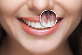 Image result for dental implant