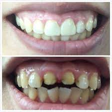 Anterior Full Contour Zirconia Very Nice Case Dental Laboratory Dental Contour