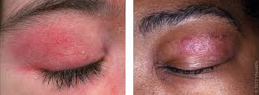 Image result for red rash face
