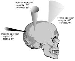 Https Thejns Org Downloadpdf Journals J Neurosurg 108 5 Article P930 Xml
