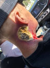 If left untreated, voice box cancer can grow and destroy more of the larynx. Head And Neck Cancer Squamous Cell Carcinoma Caused By Hpv Medicalgore