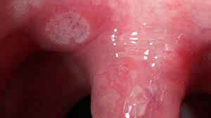 Image result for Canker sores symptoms roof of the mouth