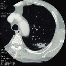 Or signs of lung cancer. Ct Scanning Of Chest Showing A Lung Cancer Of 33 Mm In The Left S 1 2 Download Scientific Diagram