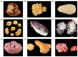 Image result for Calcium Nephrolithiasis