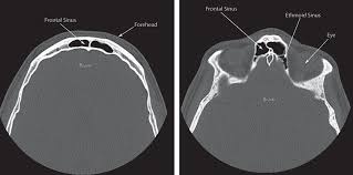 Image result for Sinus CT