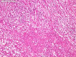 Assessment articles recommendations for pathologic analysis of malignant mesothelioma 2012 replace of the consensus declaration from the worldwide mesothelioma hobby institution. Webpathology Com A Collection Of Surgical Pathology Images