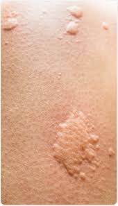 The hives treatment center has been helping people suffering from urticaria since 2001. Hives In Babies