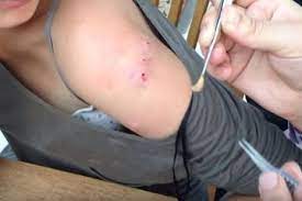 The latest tweets from perempuan (@perepmpuan). Lengan Wanita Ini Jadi Berlubang Setelah Pulang Berlibur Saat Di Cek Ditemukan Hewan Menjijikan Ini Bersarang Semua Halaman Suar