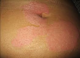 Dengan pengambilan cuka epal yang berlebihan, badan anda akan mengalami dehidrasi. Petua Hilangkan Kurap Dengan Cepat Cara Semulajadi Dan Moden