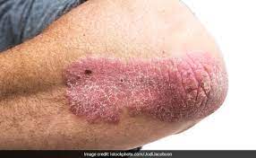Skin cancer is one of the most common types of cancer. Difference Between Psoriasis And Skin Cancer Symptoms And Risk Factors
