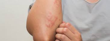 A psoríase é uma doença inflamatória crônica de pele que provoca sintomas característicos como manchas vermelhas e ressecadas, que podem causar sensação de coceira, ligeira queimação ou dor. Entenda O Que E A Psoriase Como Identificar Seus Sintomas E Qual E A Melhor Forma De Manter A Pele Em Ordem Quando Se Tem A Doenca Top Fase Seguros E